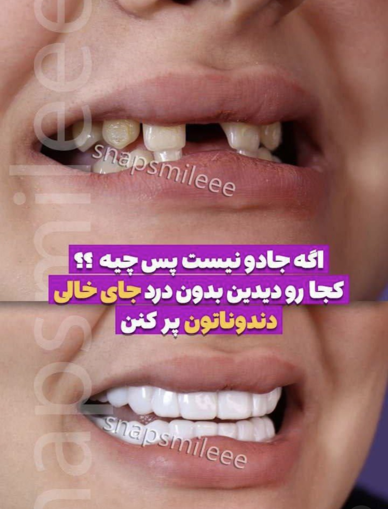 لمینت دندان دو فک اصلی همراه اسباب بازی رایگان جایزه لمینت دندان دو فک اصلی همراه اسباب بازی رایگان جایزه