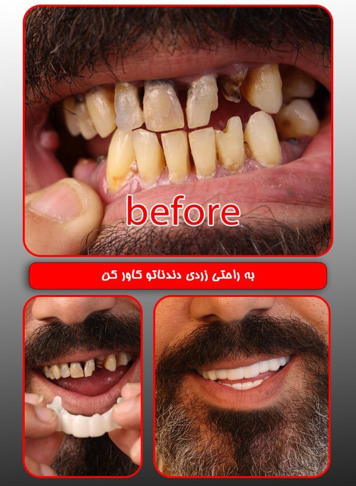 لمینت دندان دو فک اصلی برای خرابی 4 دندان vision 4 دکترفروش لمینت دندان دو فک اصلی برای خرابی 4 دندان vision 4 دکترفروش